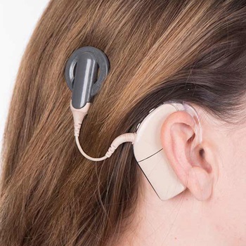 Cochlear implant in ear